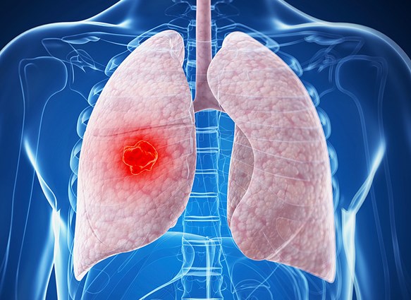 Lung Cancer<br />
<br />
<br />