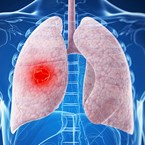 Lung Cancer<br />
<br />
<br />